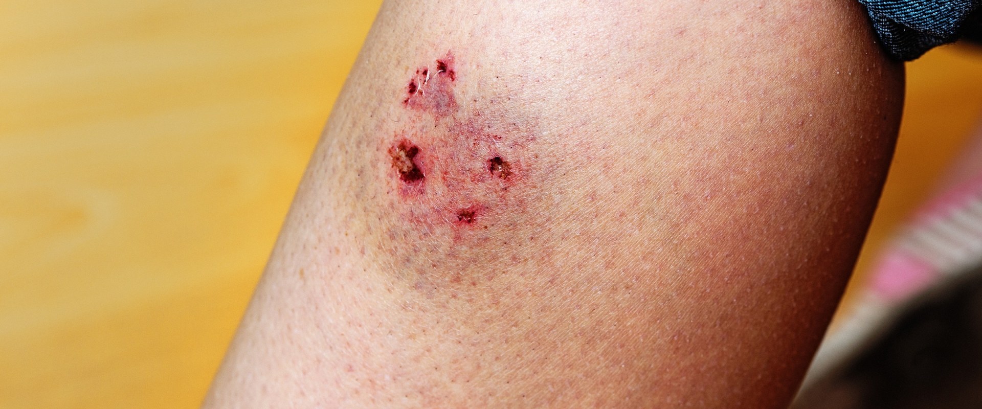 Avoid Infection Fast: How to Tell If a Cut Is Infected or Healing