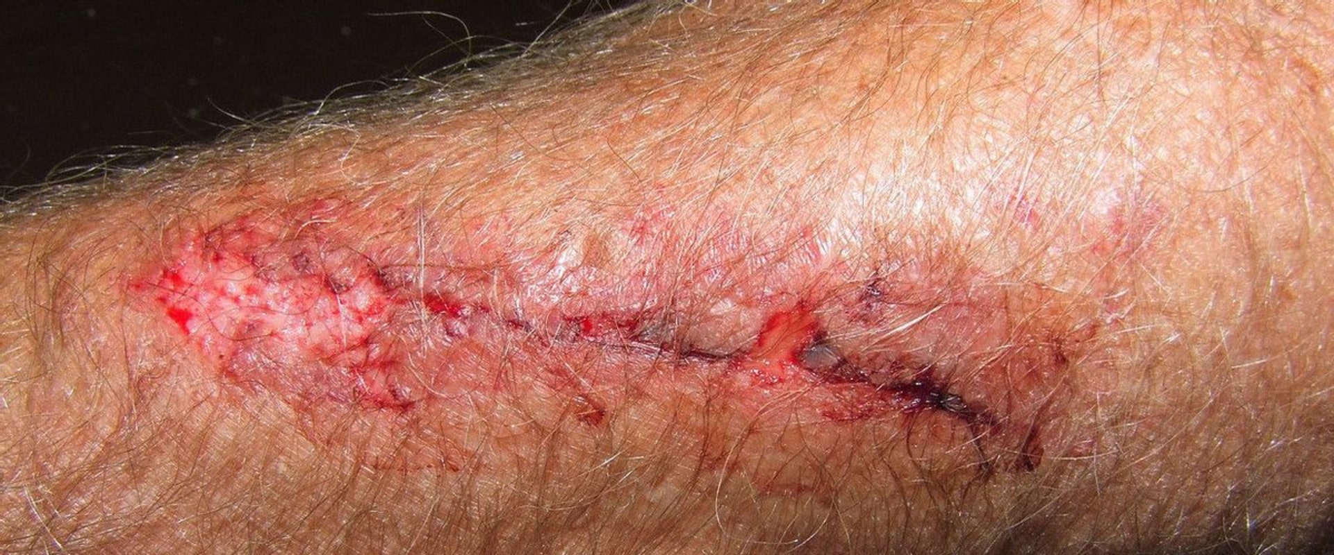 How the Body Repairs Wounds What Functions Do Clotting and Epithelial Cells Have in the Healing Process
