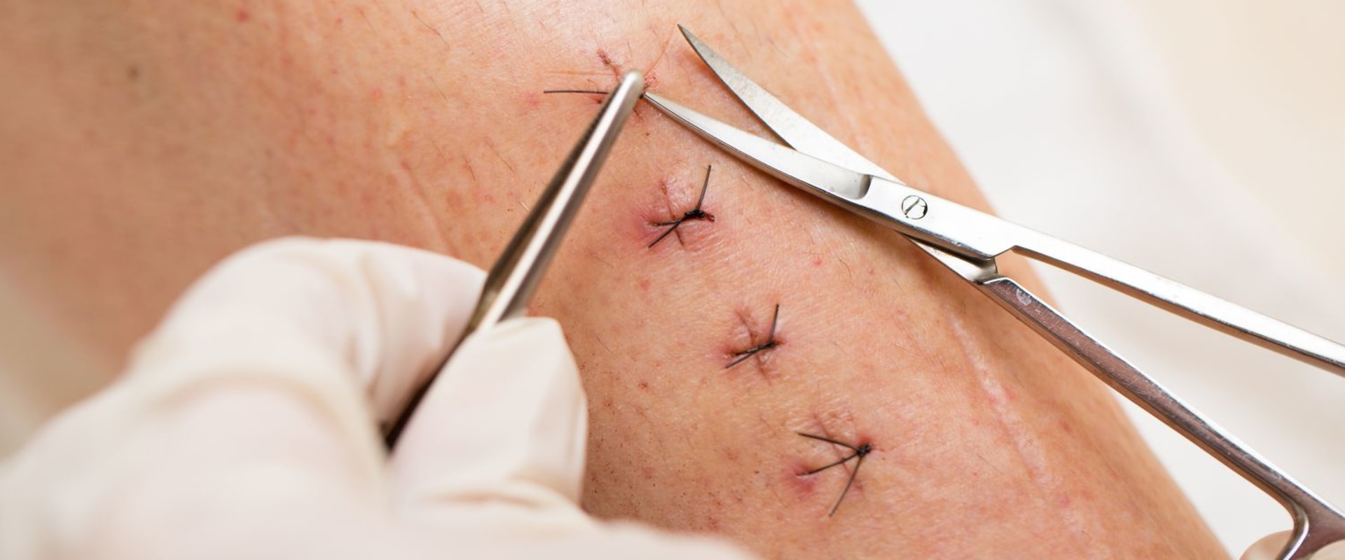 How Long Does It Take for Stitches to Heal After Surgery and What to Expect During Each Stage of Recovery