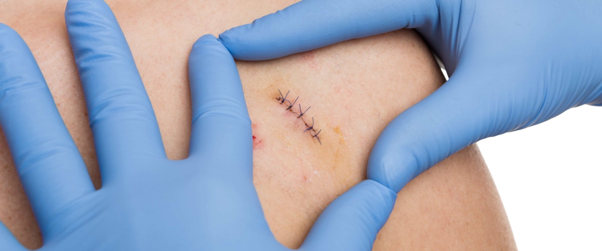 Infected Stitches: A Must-Read Guide for Safer Healing