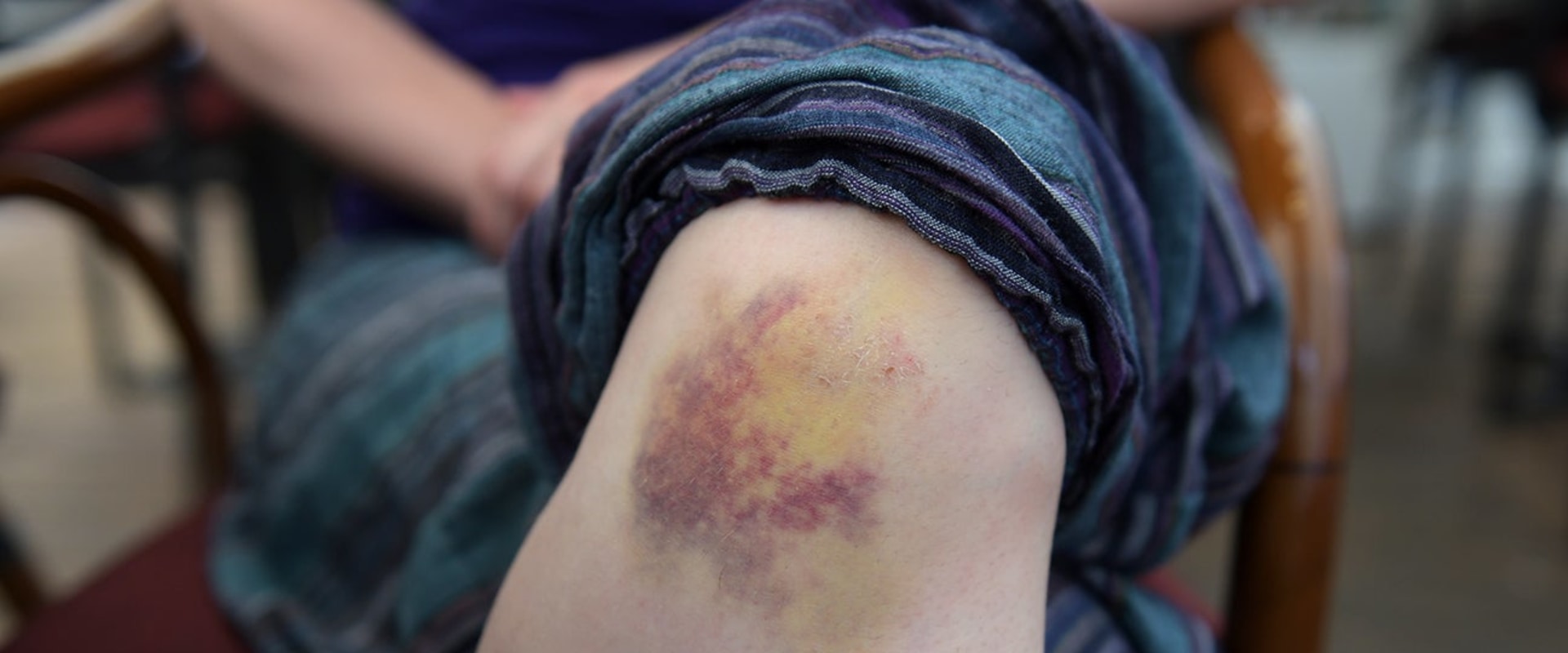 Warning Signs to Watch: Does a Blood Clot Look Like a Bruise or Indicate Something Dangerous