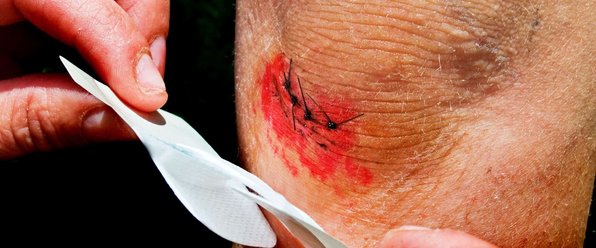 Infected Stitches Pictures That Reveal Risks & Proven Care Steps