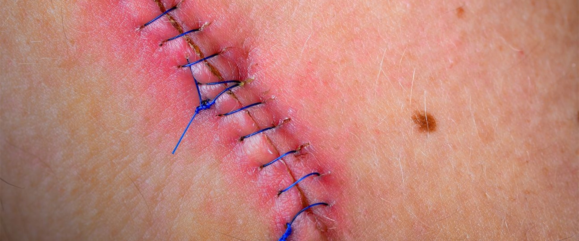 Dissolvable Stitches Healing Stages: Tips for Faster Recovery