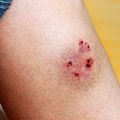 Avoid Infection Fast: How to Tell If a Cut Is Infected or Healing