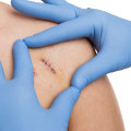 Infected Stitches: A Must-Read Guide for Safer Healing
