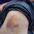 Warning Signs to Watch: Does a Blood Clot Look Like a Bruise or Indicate Something Dangerous