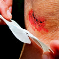 Infected Stitches Pictures That Reveal Risks & Proven Care Steps