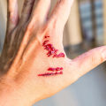 Prevent & Heal a Skin Avulsion Wound on Finger With Expert Strategies