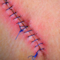 Dissolvable Stitches Healing Stages: Tips for Faster Recovery