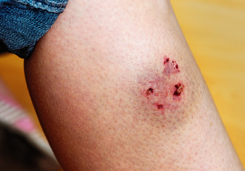 Avoid Infection Fast: How to Tell If a Cut Is Infected or Healing