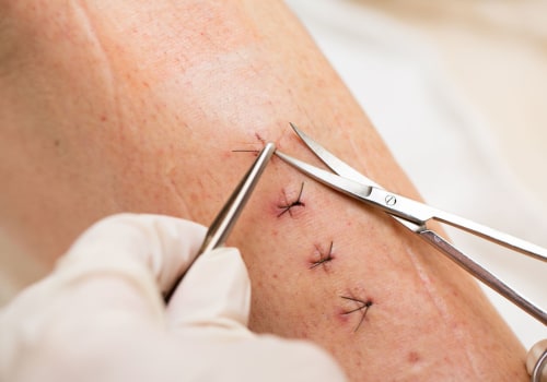 How Long Does It Take for Stitches to Heal After Surgery and What to Expect During Each Stage of Recovery