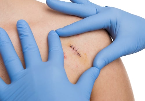 Infected Stitches: A Must-Read Guide for Safer Healing