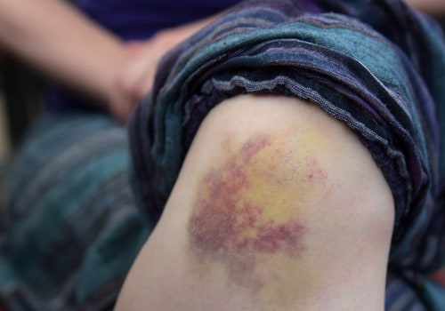 Warning Signs to Watch: Does a Blood Clot Look Like a Bruise or Indicate Something Dangerous