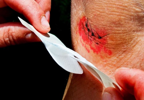 Infected Stitches Pictures That Reveal Risks & Proven Care Steps