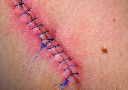 Dissolvable Stitches Healing Stages: Tips for Faster Recovery