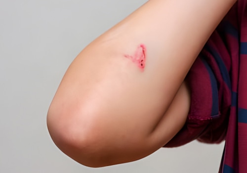 What Does an Infected Cut Look Like? Expert Tips to Identify It